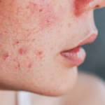mulher com manchas de acne no rosto
