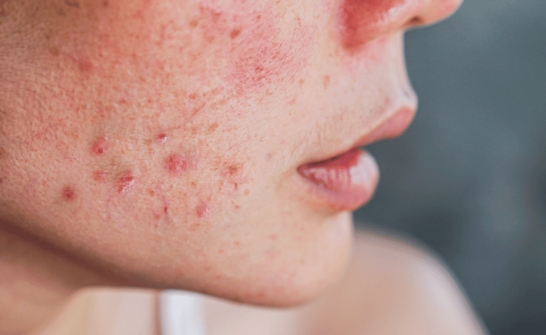 mulher com manchas de acne no rosto