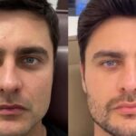 Ator Guilherme Leicam antes e depois da harmonização facial