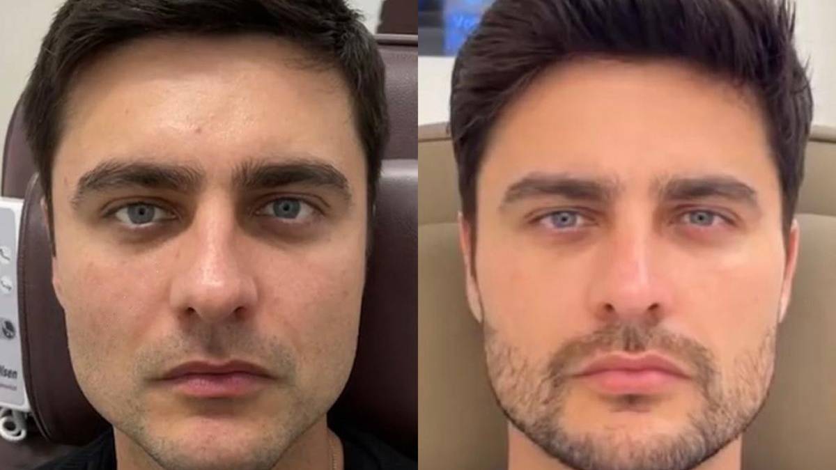 Ator Guilherme Leicam antes e depois da harmonização facial